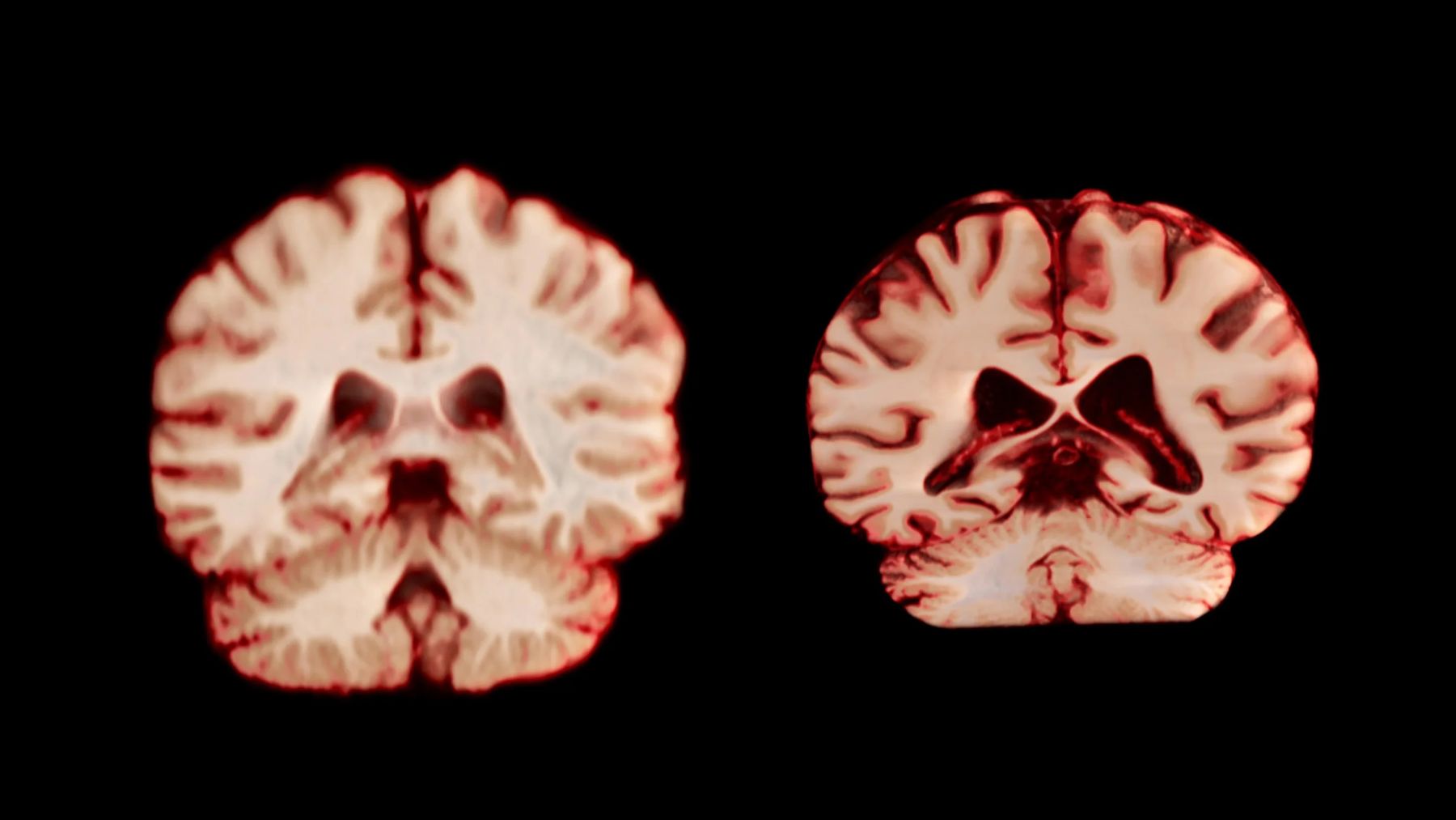 Confirmed—male brains shrink faster than female brains with age, according to an international study by the University of Oslo