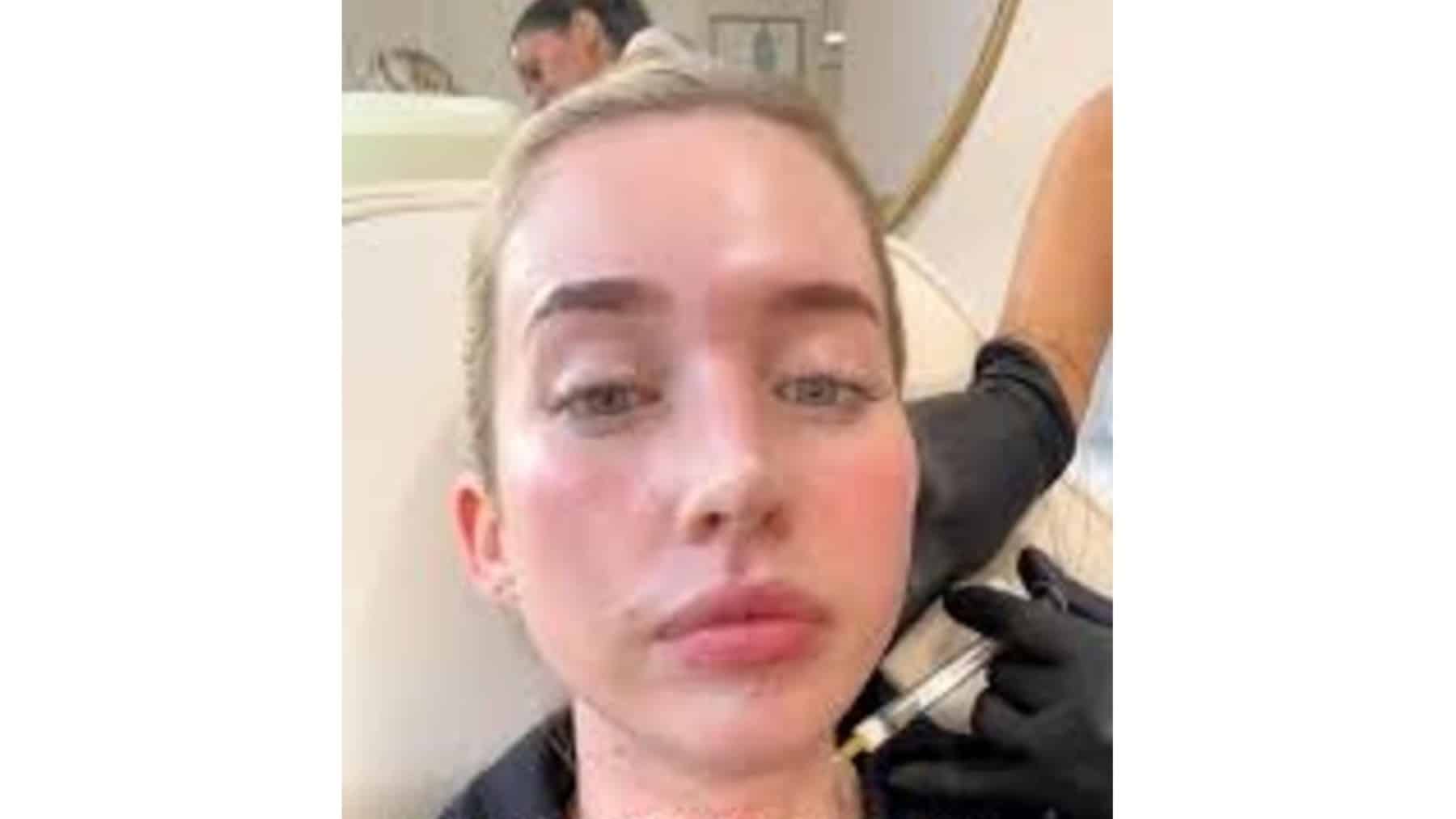 Doctors warn of the danger—the trend of “mini-facelifts” is growing among people under 35 (and experts warn of the risks)