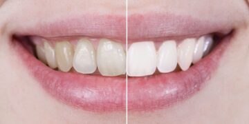 Ni bicarbonato ni limón: este es el método sencillo para blanquear tus dientes en casa.