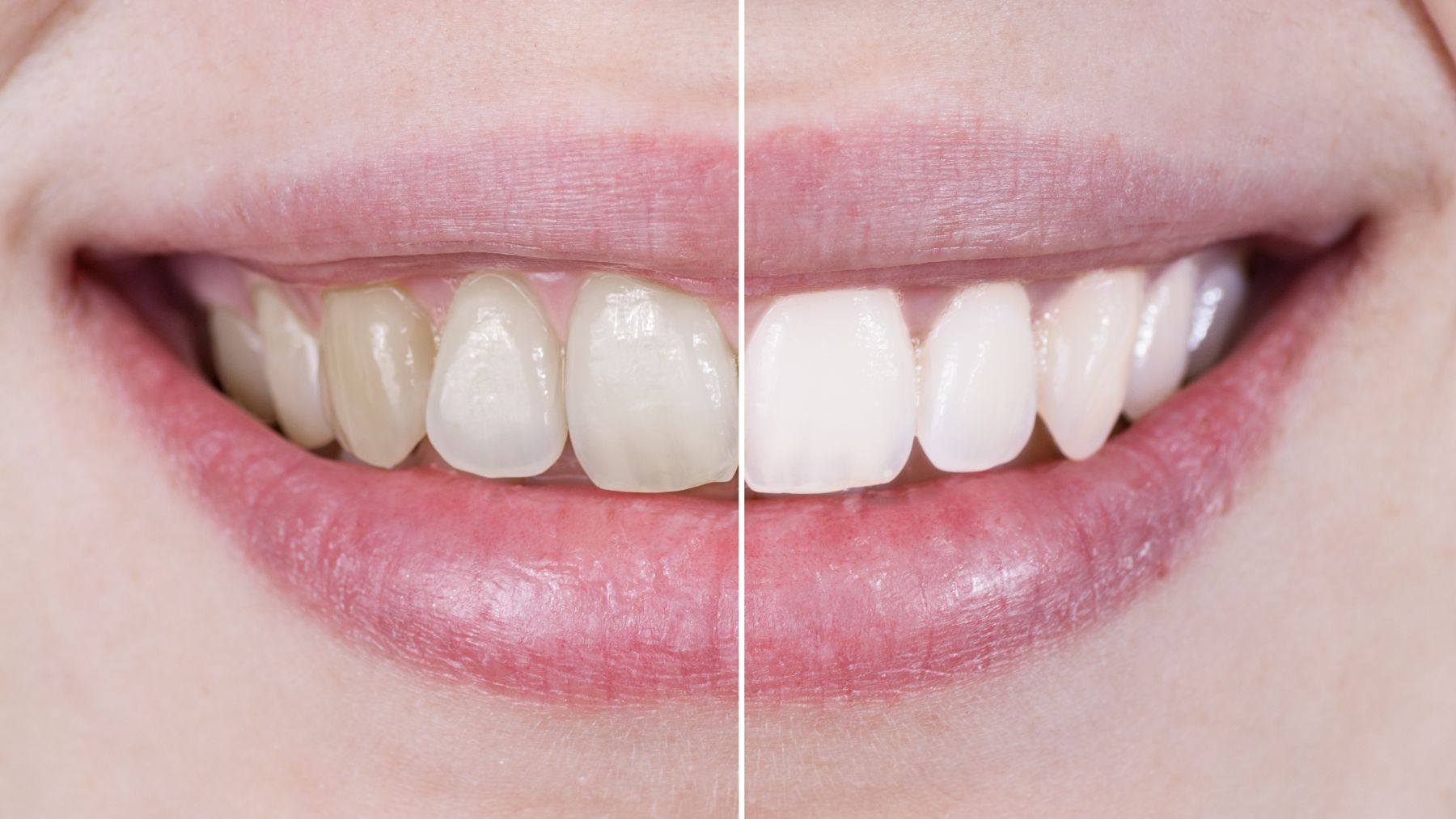 Ni bicarbonato ni limón: este es el método sencillo para blanquear tus dientes en casa.