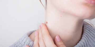 Así puedes quitar las verrugas del cuello de forma rápida y segura