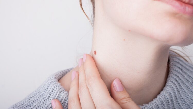 Confirmado por expertos: así puedes quitar las verrugas del cuello de forma rápida y segura 1 Así puedes quitar las verrugas del cuello de forma rápida y segura